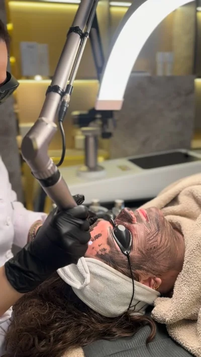 Trajtim i lëkurës me carbon laser peel