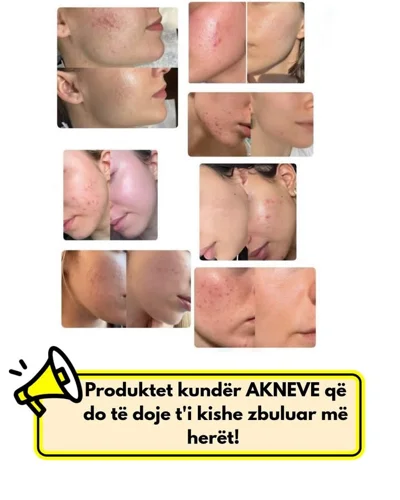 Produkte kundër akneve për lëkurën e fytyrës