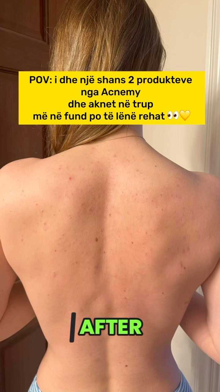 Produkte Acnemy kundër akneve në trup – Una Beauty