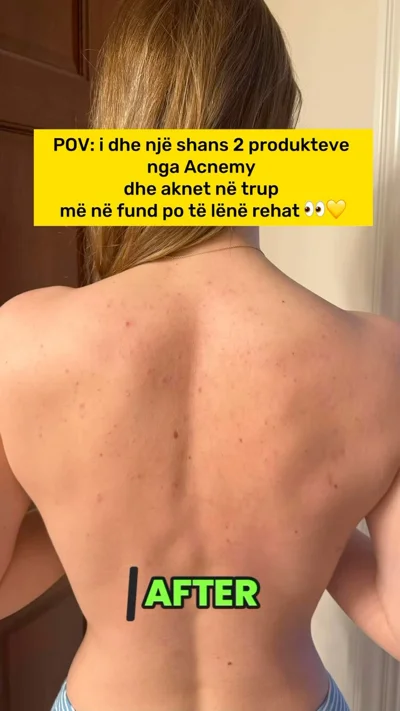 Produkte Acnemy kundër akneve në trup